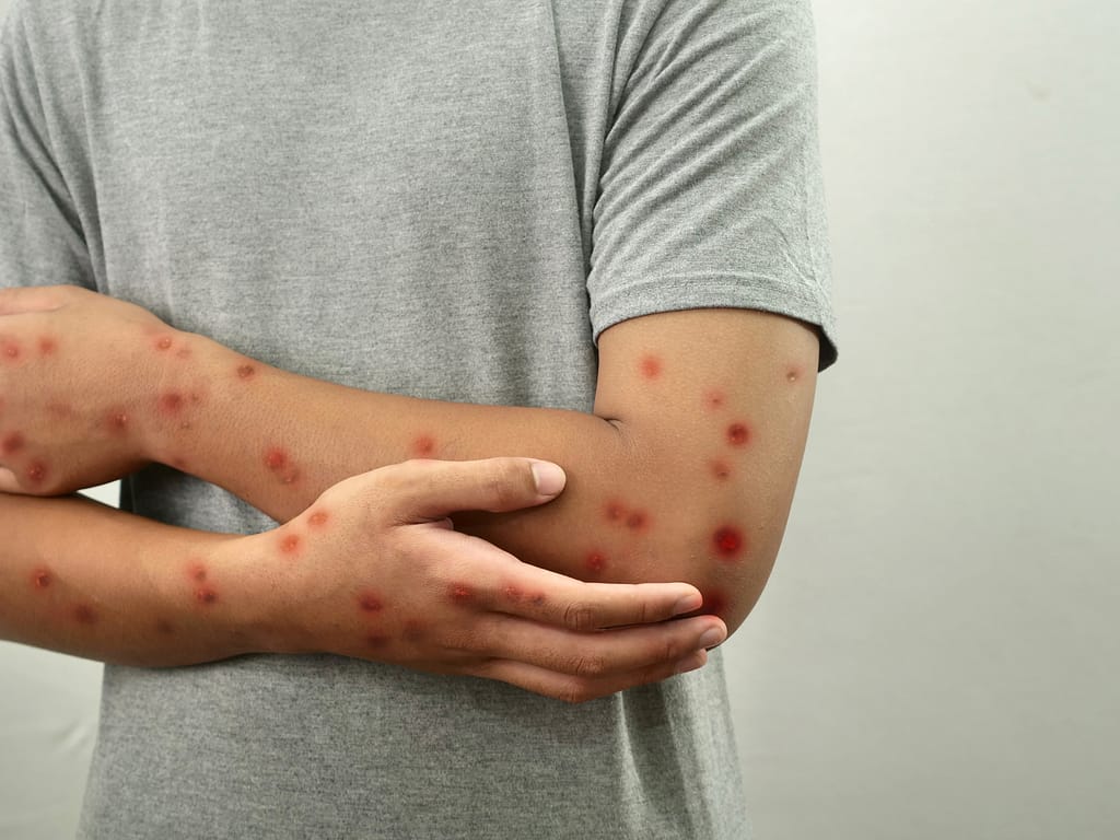 mpox